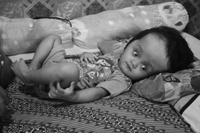 Nurul Inaya, balita berusia 2 tahun 4 bulan itu menderita  hydrocephalus. Foto: Gustam Jambu/cermat 