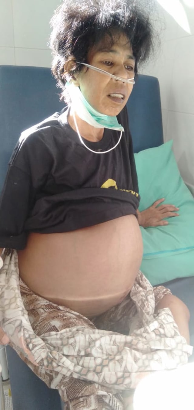 Hamidah, warga Mempawah yang menderita tumor perut. Foto: Dok Hi!Pontianak