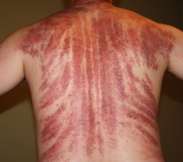 Ilustrasi Gua sha. Sumber: Wikimedia commons