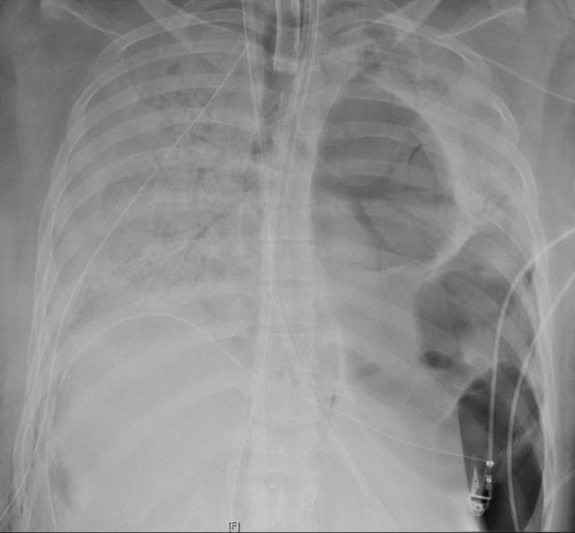 Rontgen paru-paru dari pasien sebelum ia menerima transplantasi menunjukkan kerusakan parah Foto: Northwestern Medicine