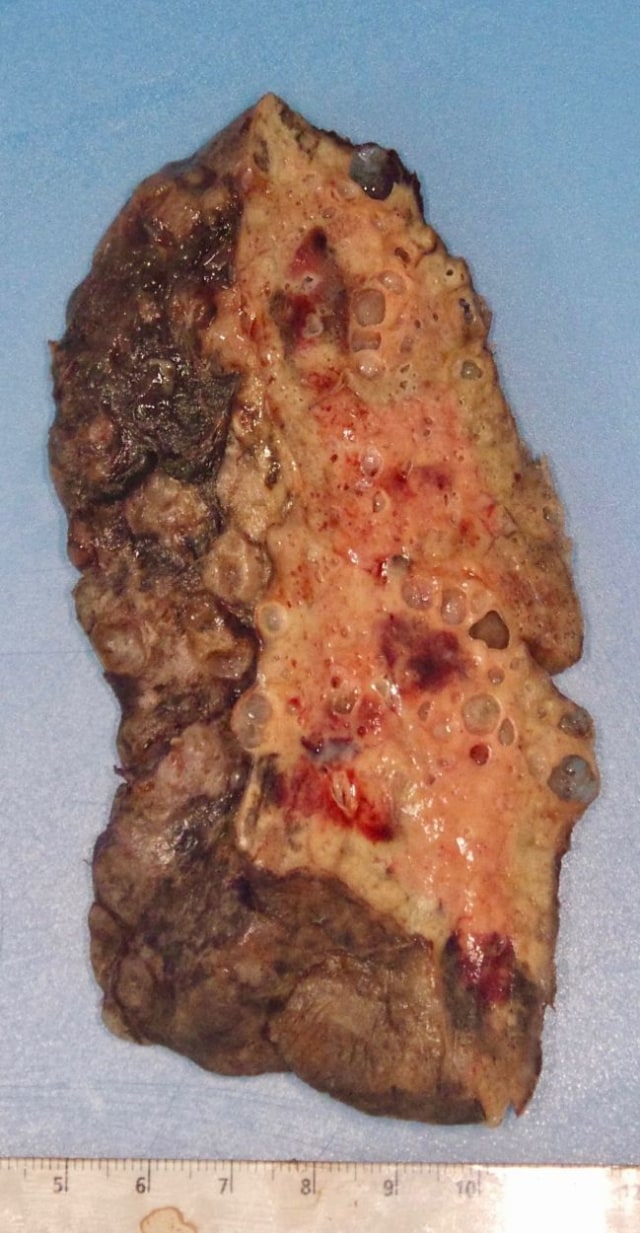 Salah satu paru-paru yang diambil dari pasien menunjukkan kerusakan besar. Foto: Northwestern Medicine
