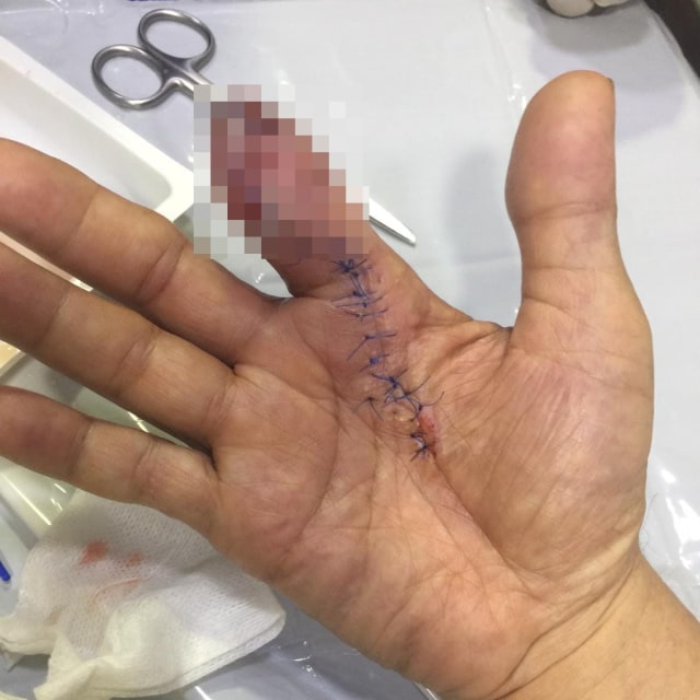 Jari Pria Ini Hilang Setelah Bersihkan Udang, Apa yang Terjadi? (340220)