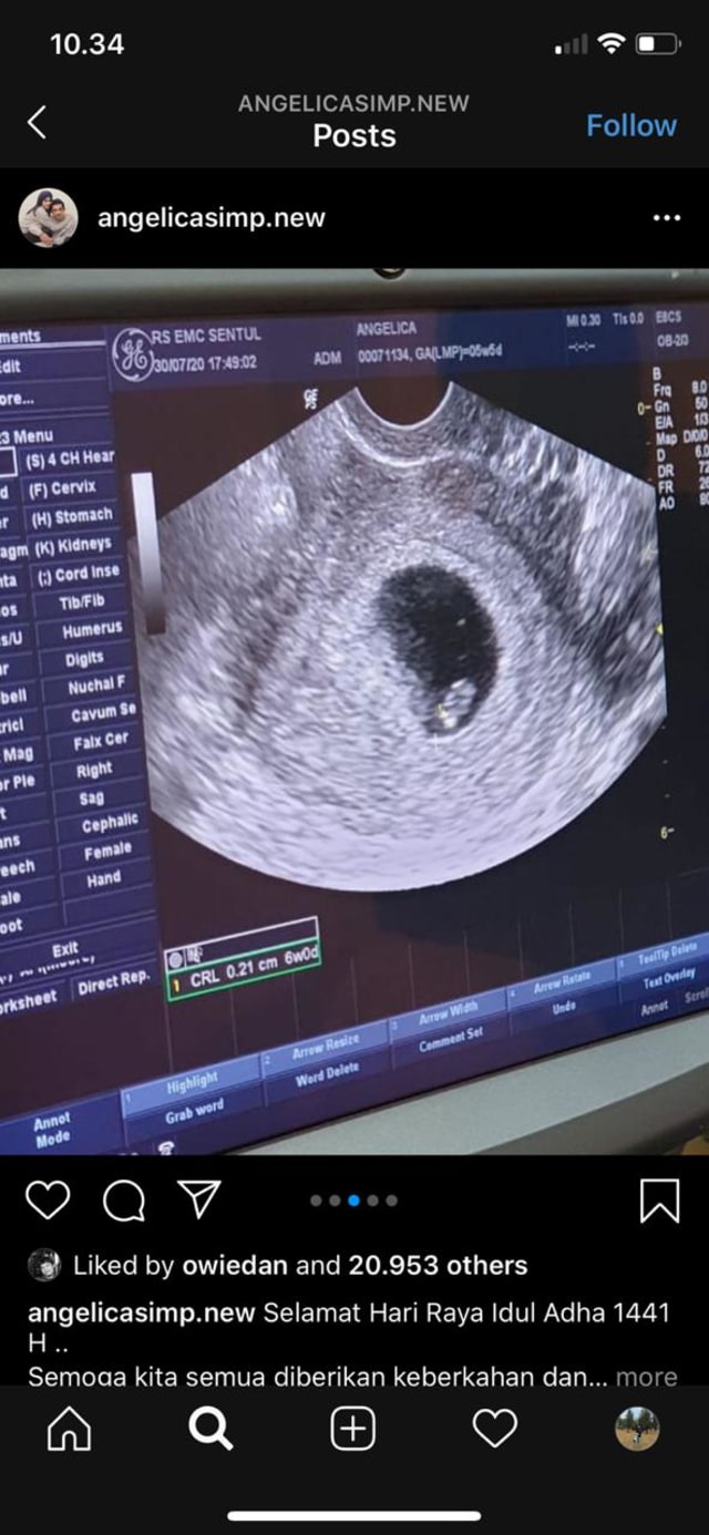 Sebulan Menikah, Angelica Simperler Hamil Anak Pertama (217752)