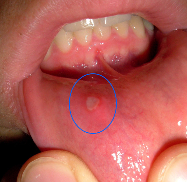 Sakit sariawan pada rongga mulut. Foto: Wikimedia Commons