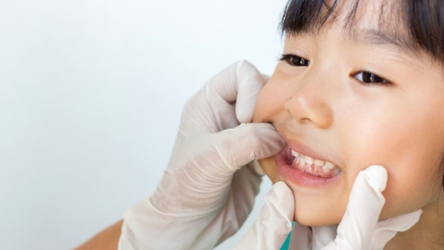 Ilustrasi masalah gigi pada anak. Foto: Shutter Stock