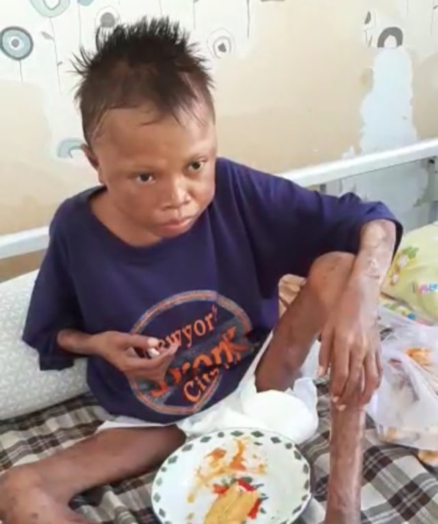 kumparanDerma Salurkan Bantuan untuk Dion, Remaja Penyakit Kulit dan Gizi Buruk (175925)