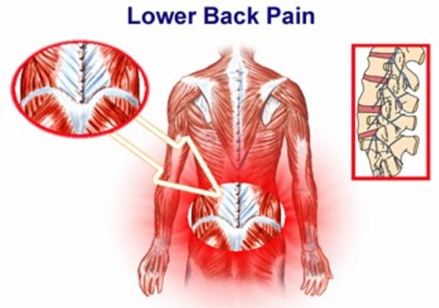 MENGAPA PERAWAT BISA MENGALAMI LOW BACK PAIN (LBP) ?