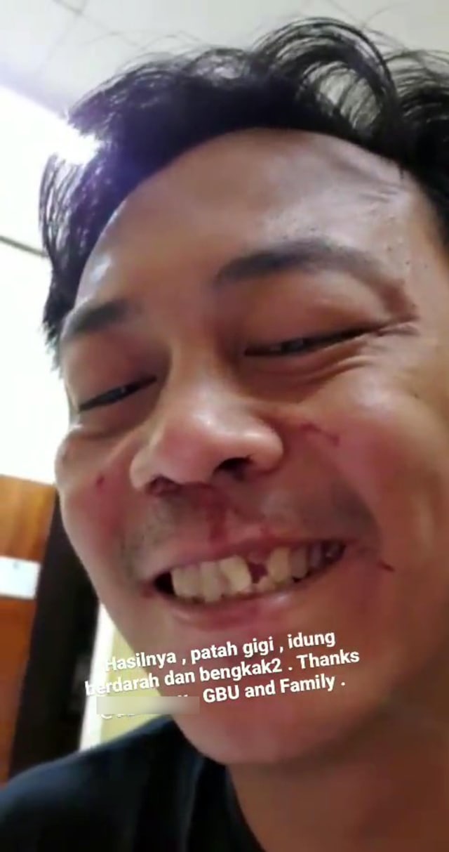 Gio Idol menunjukan giginya yang patah akibat ditampar oleh teman perempuannya (Capture Instagram Story @GioLelaki) 