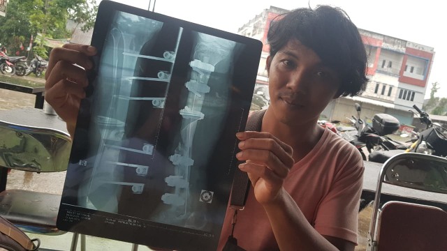 Petrus menunjukkan foto tulang kakinya yang patah. Foto: Leo Prima/Hi!Pontianak