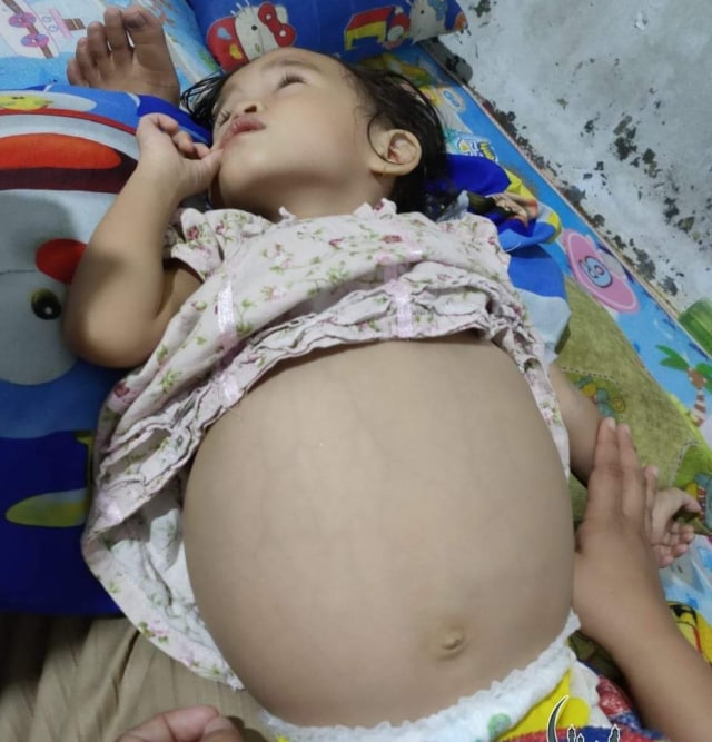 Fhaiqa, Balita Penderita Perut Buncit di Parigi Moutong, Sulteng, Butuh Bantuan (113442)