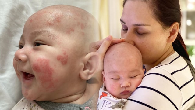 Penyebab Si Kecil Alami Dermatitis Atopik, seperti Bayi Mona Ratuliu (73785)