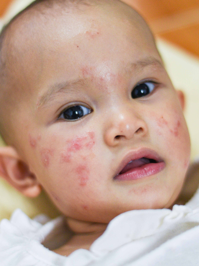 Makanan agar Dermatitis Atopik pada Bayi Membaik, Ada Enggak Sih? Foto: Shutter Stock