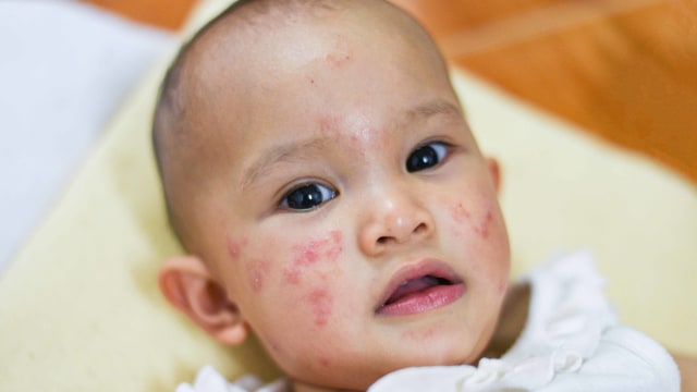 Ilustrasi anak mengalami infeksi kulit dermatitis atopik atau eksim susu. Foto: Shutter Stock