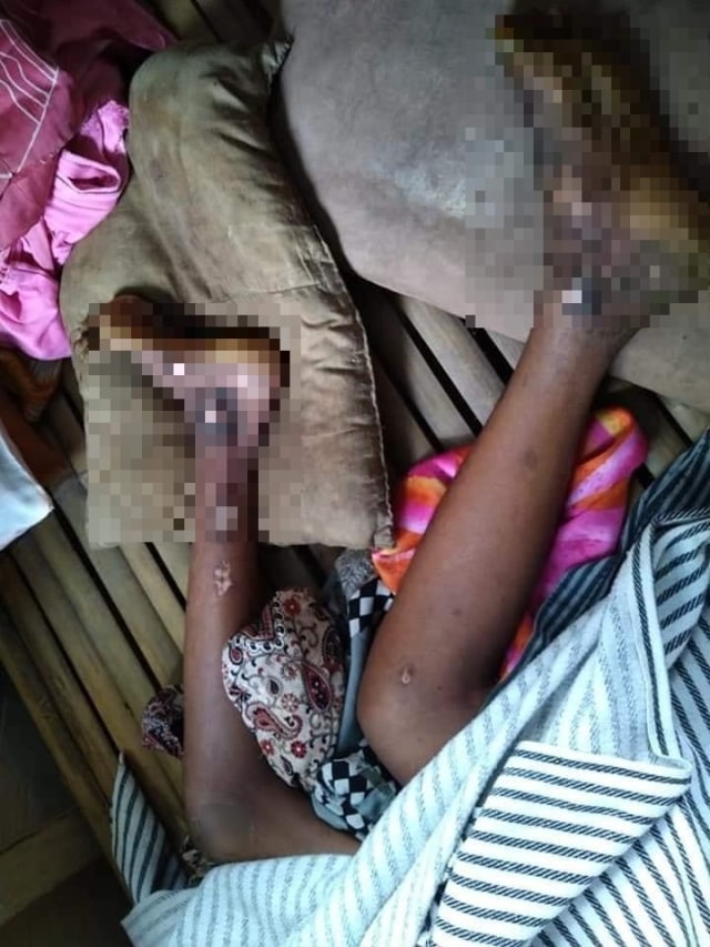 Kisah Pilu Astain, Anak Yatim di Donggala yang Alami Penyakit Aneh (76168)