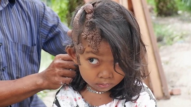 ZAHRA, anak perempuan 6 tahun dengan kondisi daging tumbuh menyelimuti kepalanya. 