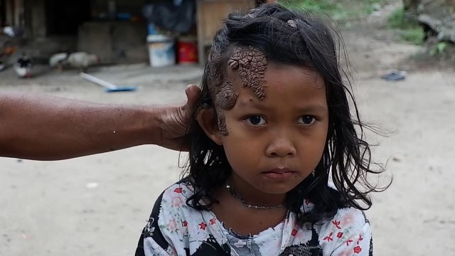 ZAHRA, anak perempuan berusia 6 tahun dengan kondisi daging tumbuh selimuti kepalanya.  