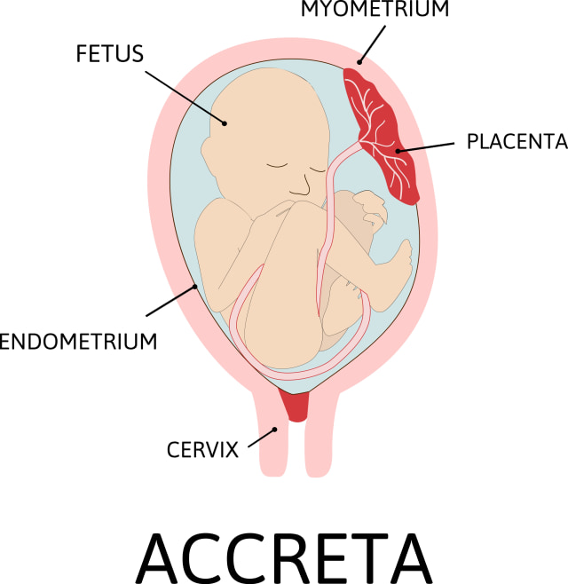 Cerita Alice Norin Melahirkan dengan Kondisi Placenta Previa Totalis Accreta (208210)