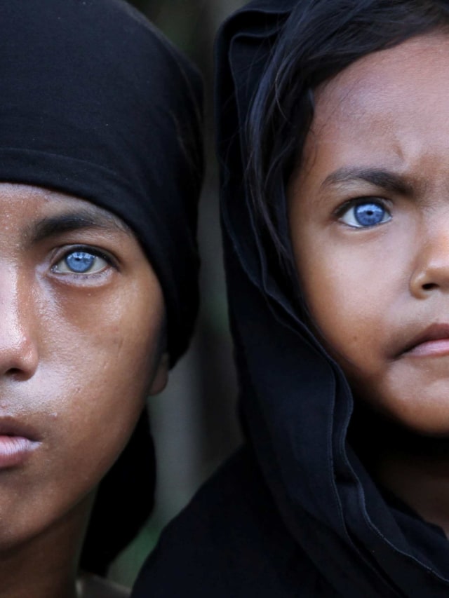 Syawal (kiri) dan Eni Wahyuni (kanan) menunjukan bola mata berwarna biru dan kemerahan di Kendari, Sulawesi Tenggara. Foto: Jojon/Antara Foto