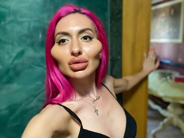 Pemilik Pipi Terbesar di Dunia Ketagihan Filler karena Dulu Wajahnya Mirip Tikus. Foto: dok. Instagram Anastasia Pokreshchuk
