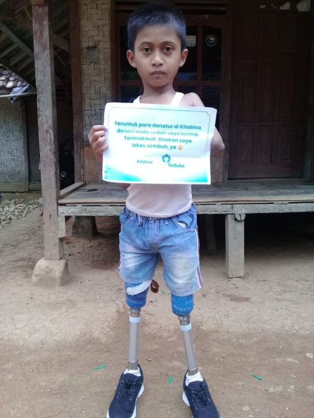 Berjalan 1 KM Hanya Dengan Sebelah Tangan, Kini Arsim Miliki Kaki Baru (12425)