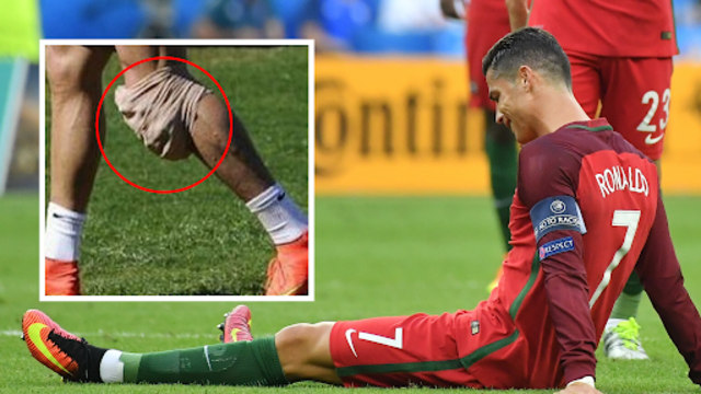 Cristiano Ronaldo cedera ACL pada perhelatan Final Piala Eropa 2016 (https://images.app.goo.gl/5vZTUNfyDmJ1fsfV9)
