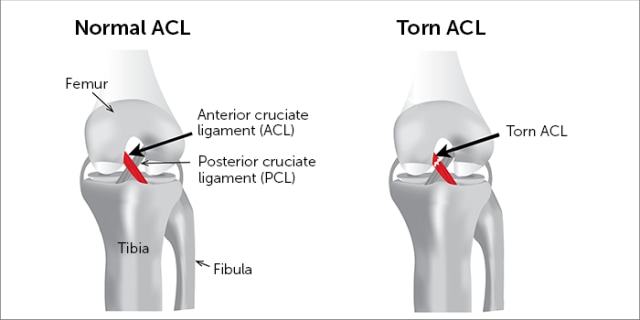 Tentang Cedera Ligamen Lutut Anterior (ACL) dan Pesepak Bola yang Mengalaminya (379373)