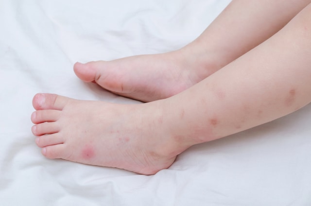 Apakah Alergi pada Orang Tua Bisa Menurun ke Anak? (7779)