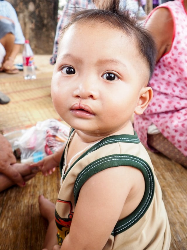 Penyebab anak bibir sumbing Foto: Shutterstock