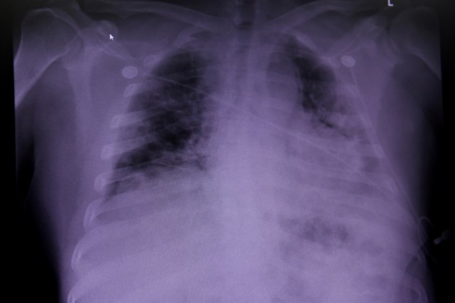 Rontgen paru-paru pasien COVID-19 di United Memorial Medical Center di Houston, Texas, AS, 10 Juli 2020. Foto: Callaghan O'Hare/REUTERS 