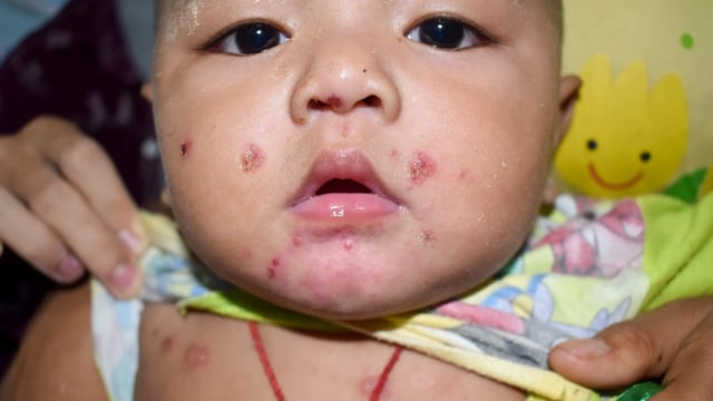Kulit Anak Bintil-Bintil? Waspada, Mungkin Si Kecil Kena Penyakit Menular Ini! (250192)