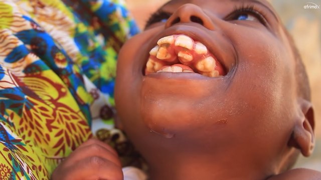 Bocah dengan 70 gigi di Afrika. Foto: YouTube/Afrimax 