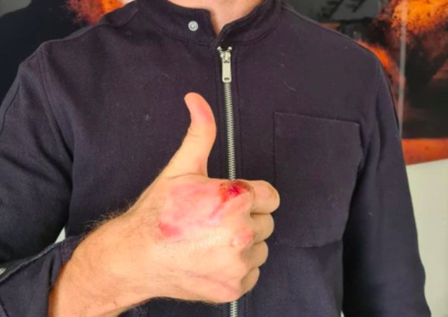 Romain Grosjean Buka Perban, Luka Bakarnya Serem Banget (391198)
