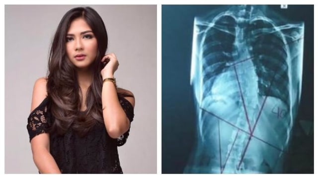 Alami Kelainan Tulang Belakang, Cerita Perjuangan 5 Artis Sembuh dari Skoliosis (649155)