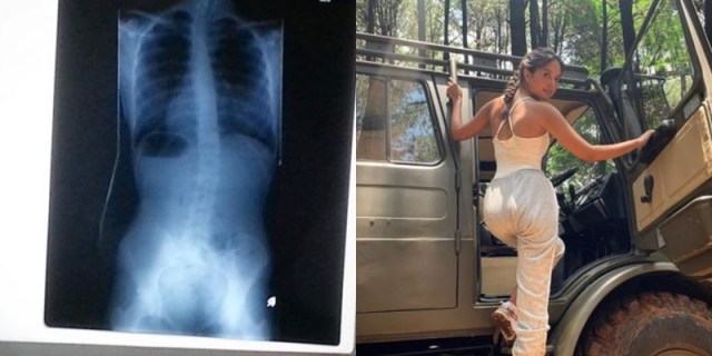 Alami Kelainan Tulang Belakang, Cerita Perjuangan 5 Artis Sembuh dari Skoliosis (649160)