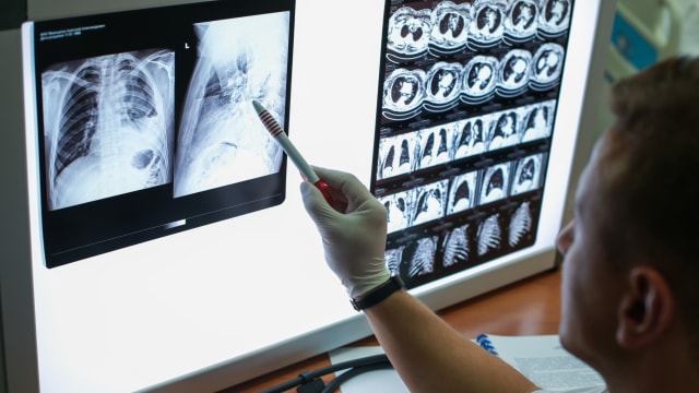 Ilustrasi dokter memeriksa sel kanker. Foto: Getty Images