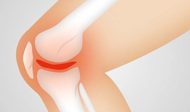 Ilustrasi gangguan nyeri sendi atau osteoarthritis pada lansia/Pixabay.