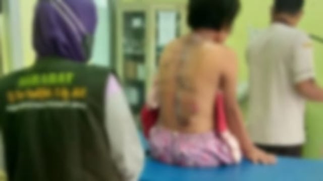 Seorang gadis di Brebes ini mengalami luka memar dan kulit melepuh akibat dianaya ayah tiri.