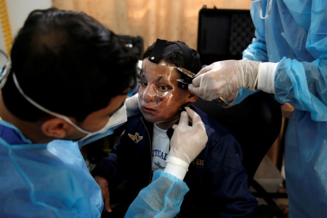 Foto: Pembuatan Topeng 3D Transparan Bagi Penderita Luka Bakar di Gaza (99022)