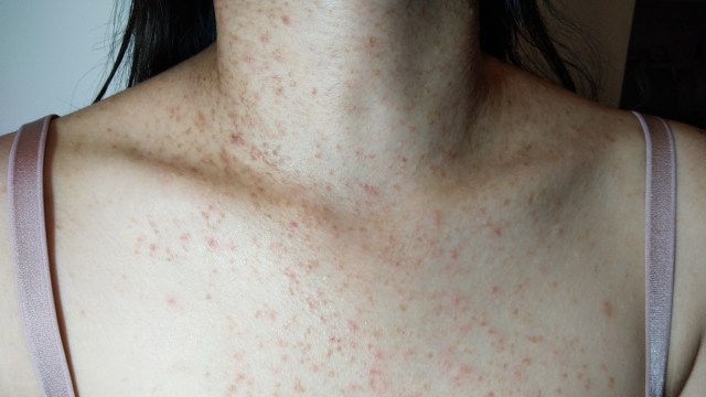 Ilustrasi Fungal Acne. Foto: Shutter Stock