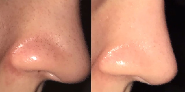 gambar blackhead pada hidung. Foto: Marieclaire