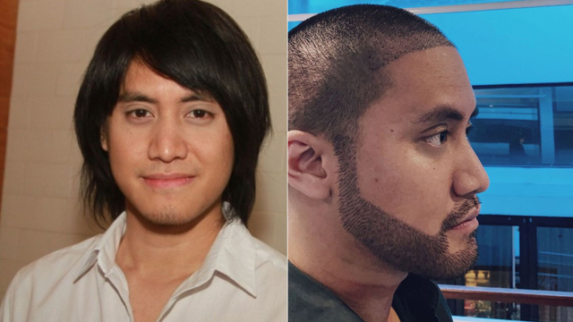 Kevin Aprilio sebelum dan sesudah transplantasi rambut. Foto: Instagram @kevinaprilio