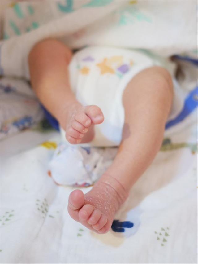 Panjang Kaki Bayi Tidak Sama, Apakah Harus Khawatir? Foto: Freepik