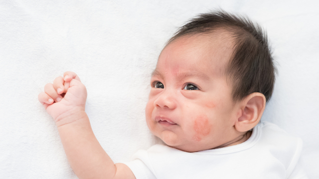 Dermatitis atopik pada bayi. Foto: Shutter Stock