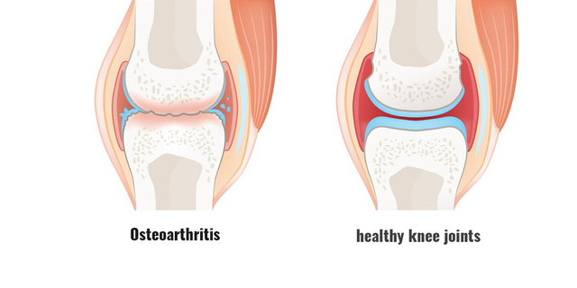 Osteoarthritis: Penyebab, Gejala, dan Tatalaksananya (360435)