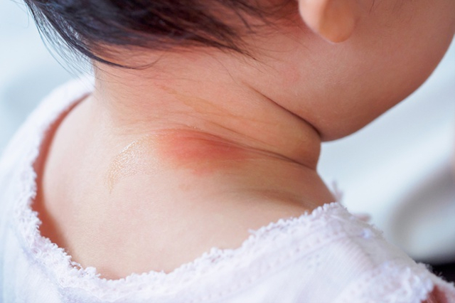 Obat Biang Keringat pada Bayi, Alami dan Bisa Dicoba (161382)