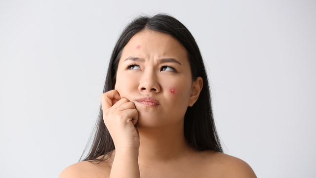 Jerawatan, Tanda Hamil Bayi Laki-laki atau Perempuan? Foto: Shutterstock
