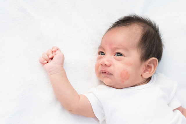 Ruam kulit pada bayi baru lahir. Foto: Shutterstock