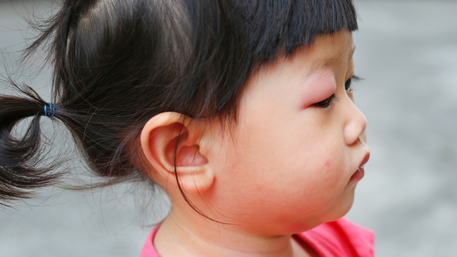 Ilustrasi mata bayi bengkak karena alergi Foto: Shutterstock