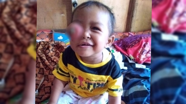 Naysila Putri, 3 tahun, menderita kelainan di mata. (Foto: Dok Ruminah)