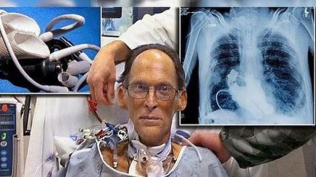 Craig Lewis menjadi manusia pertama yang hidup tanpa jantung pada 2011. Foto: Istimewa